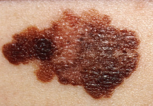 Más de 8.000 personas son diagnosticadas por melanoma anualmente en España