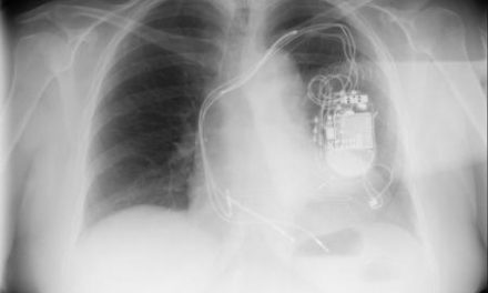 Cardiólogos extremeños utilizan por primera vez en España una técnica para resincronización cardíaca