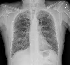 La Enfermedad Pulmonar Obstructiva Crónica, EPOC, afecta a un 10% de la población extremeña