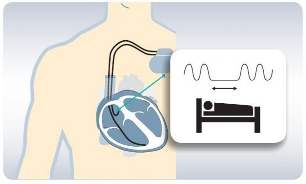 El Hospital Infanta Cristina implanta en Extremadura el primer marcapasos que detecta las apneas del sueño