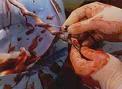 La comunidad autónoma de Extremadura registra 836 unidadades de sangre de cordón umbilical