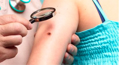 Los expertos diagnostican en Extremadura 699 cánceres de piel en sólo un año