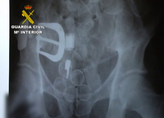 Unas radiografías confirman que escondió en su organismo droga para introducirla en la cárcel de Badajoz